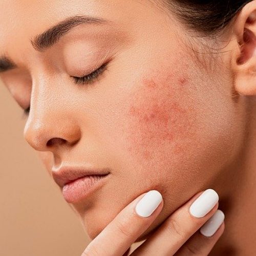 acne scarring easy dermatologist